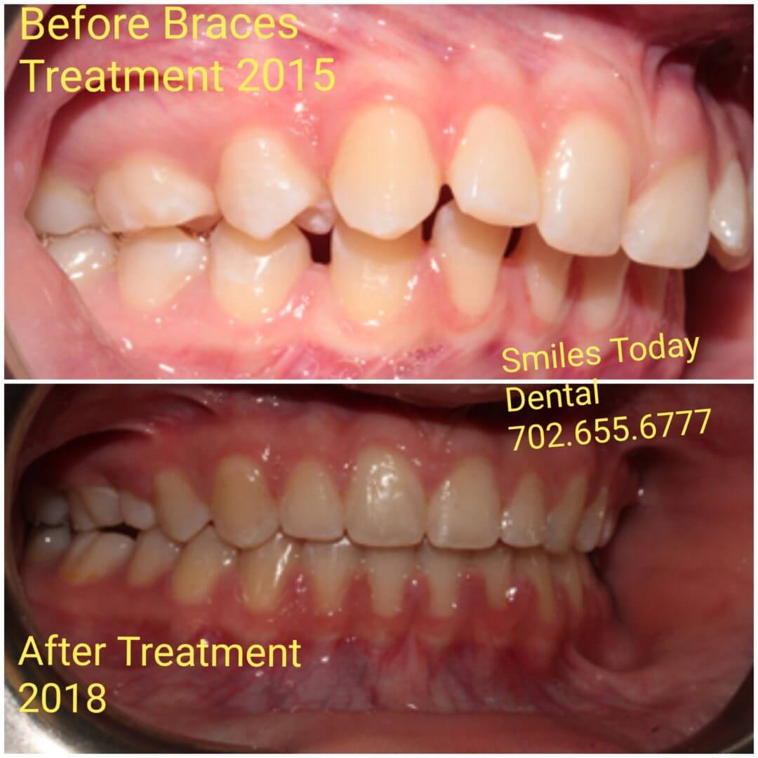 Braces In Las Vegas Smiles Today Dental 