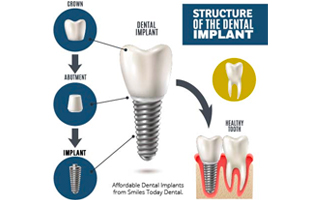 What Is The Best Type of Dental Implant For Me?