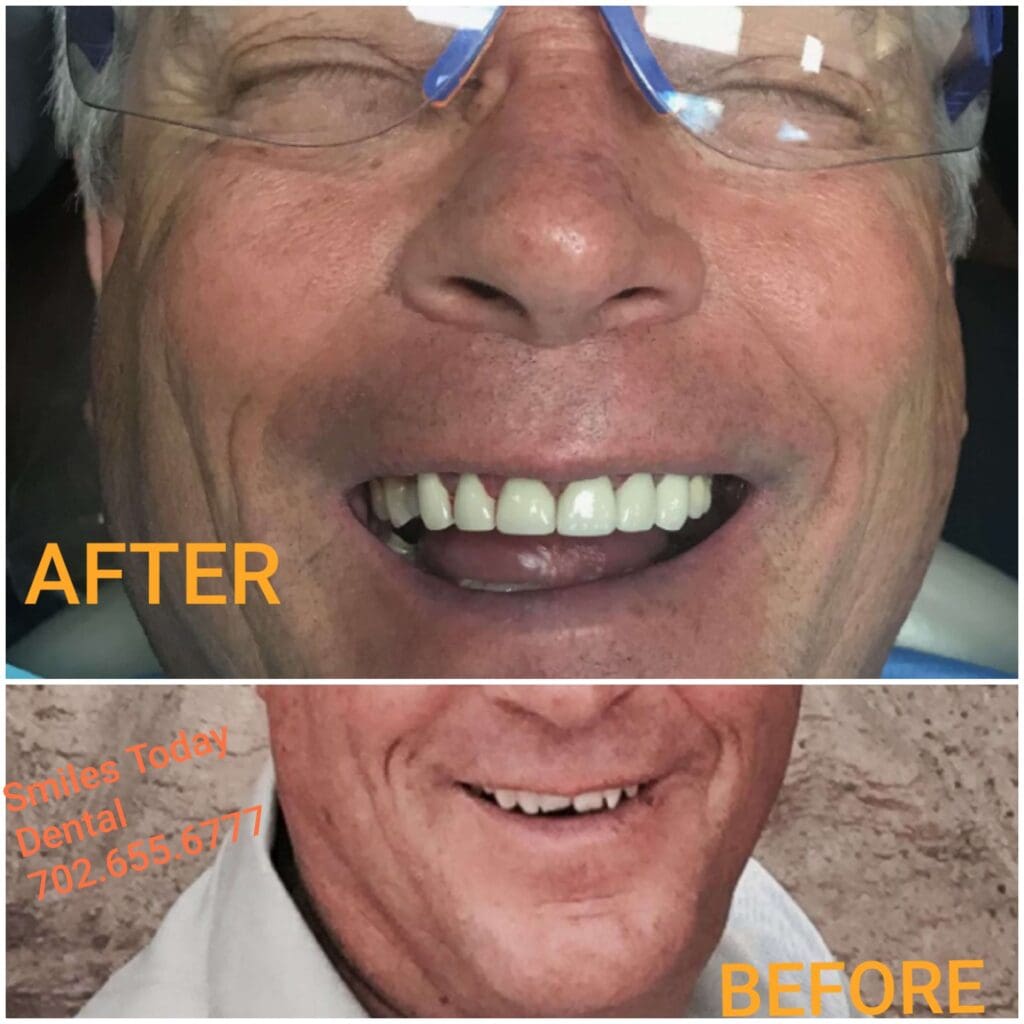before and after dental crown