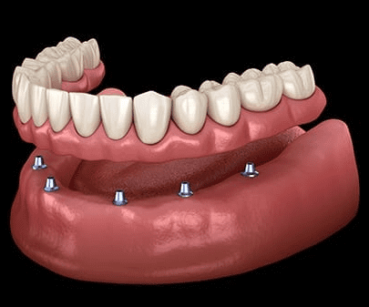 implant-retained dentures implant-supported dentures dentist in Las Vegas NV