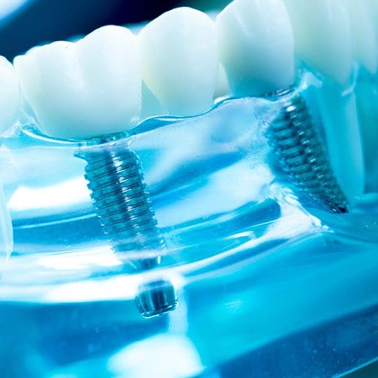 Implant-Supported Dentures: The Ultimate Hybrid Option