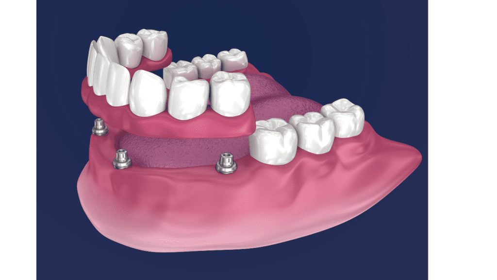 all on 4 implants model
