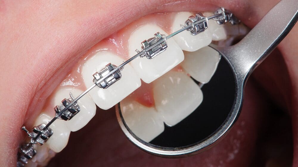 When Should You See an Orthodontist in Las Vegas - Smiles Today Dental