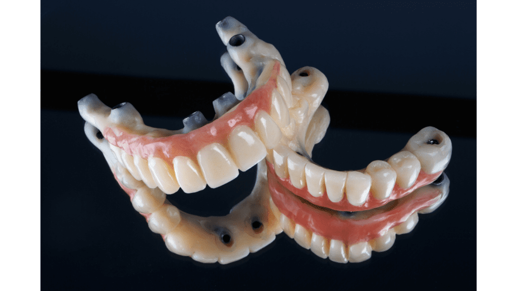 all on 4 dental implant impression