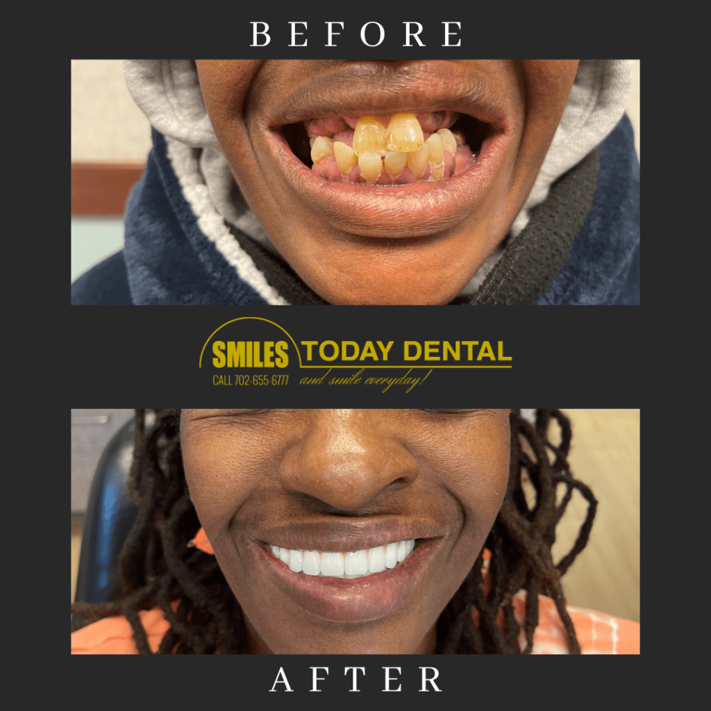 dental implants in Las Vegas - before and after of female patient
