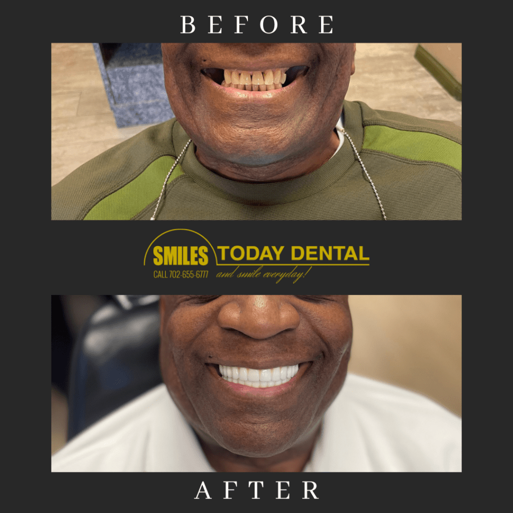 dental implants in Las Vegas - before and after of male patient